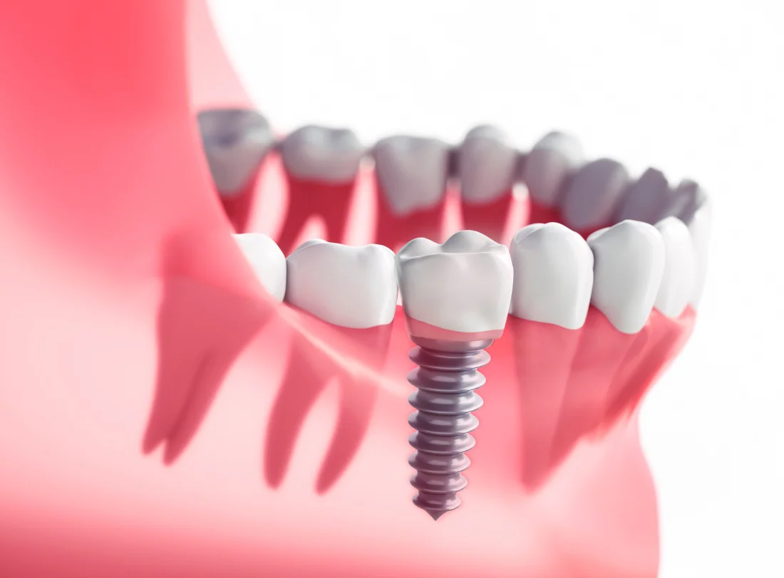 Croydon Dental Implants Dentist Offers Consultations at Smile 4 U Dental Practice