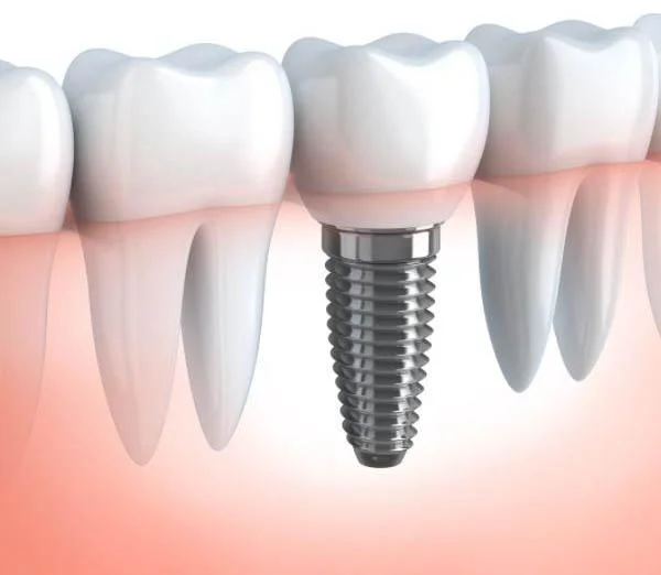 Dental Implants Dentist Wilmslow Announces Appointment Availability for New Patients at The Croft Dental & Implant Practice